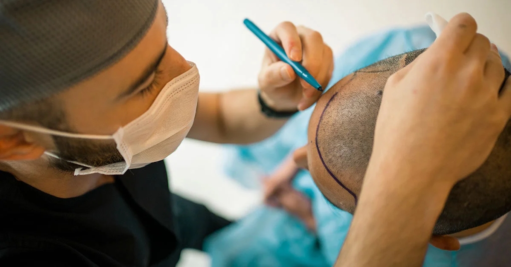 Recovery and Aftercare Tips for a Successful Hair Transplantation