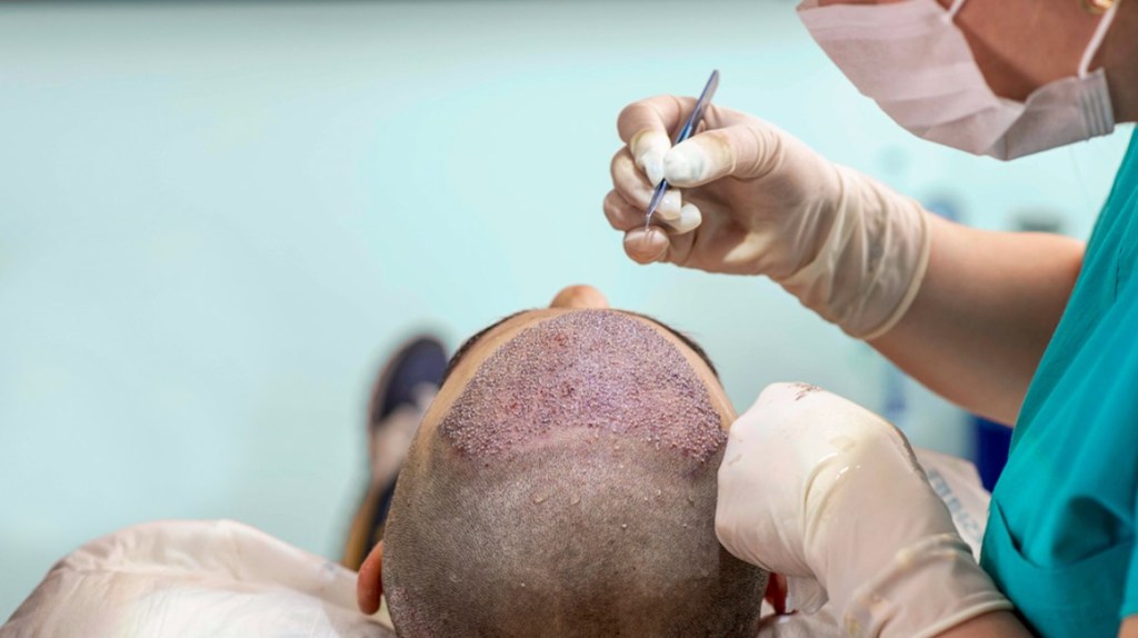 Common Myths and Misconceptions About Hair Transplantation